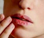 जाडोमा छाला फुट्ने समस्या र उपचारको विधि के ?