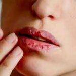 जाडोमा छाला फुट्ने समस्या र उपचारको विधि के ?