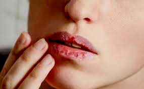 जाडोमा छाला फुट्ने समस्या र उपचारको विधि के ?